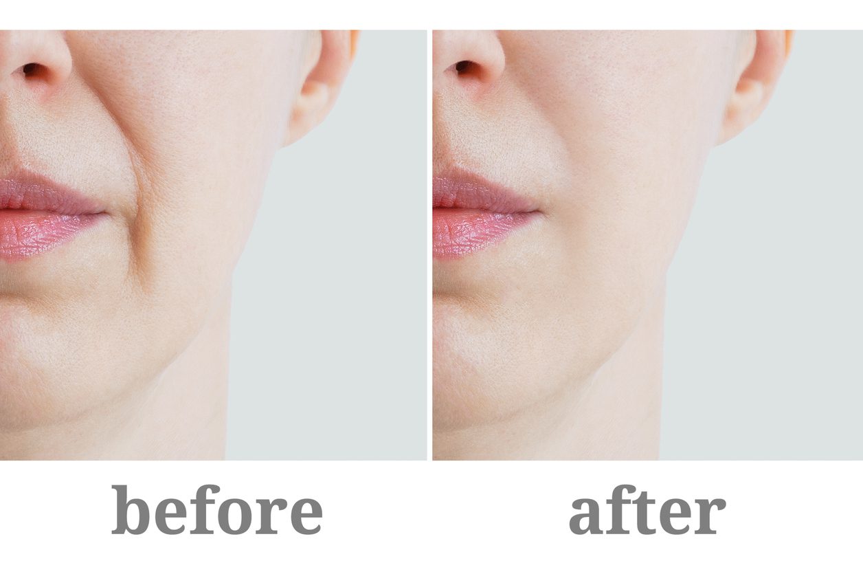 Facial Fillers Explained Expert Insights on Oculofacial Plastics